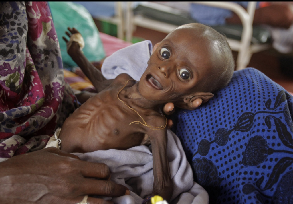 Somalian famine baby